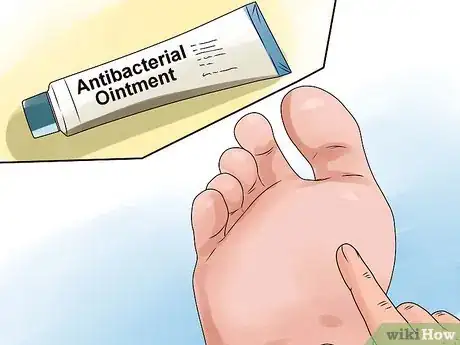 Immagine titolata Care for a Burst Blister Step 5
