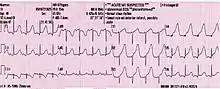 Infarto miocardico acuto anteriore esteso: il segmento ST è sopralivellato nelle derivazioni anteriori DI, DII, V1, V2, V3, V4, V5, V6 e sottolivellato nelle derivazioni speculari inferiori DIII.