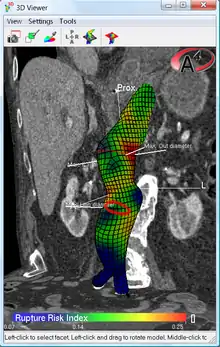 Predittore del rischio biomeccanico di rottura di un AAA