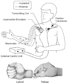 Uno schema della neuroprotesi che mostra l'unità di controllo esterna e il trasduttore di posizione montato sulla spalla, insieme allo stimolatore e agli elettrodi impiantati. Sono mostrate anche illustrazioni di prensione laterale e palmare.