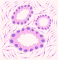 Rappresentazione BAdenocarcinoma: la presenza di strutture ghiandolari più o meno differenziate testimonia la natura della neoformazione.