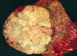 Immagine BAdenocarcinoma polmonare: grande massa periferica, lobulata e dall'aspetto traslucido.