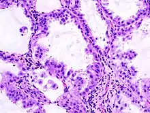 Immagine istologica C1Carcinoma bronchioloalveolare: le cellule neoplastiche tappezzano i setti interalveolari rispettandone la struttura.