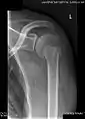 Una radiografia che mostra una lesione di Bankart ossea con un frammento stazionario nella glena inferiore