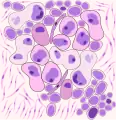 Rappresentazione DCarcinoma polmonare a grandi cellule: il quadro è dominato da pleomorfismo marcato, con elementi cellulari giganti frammisti a cellule immature, con nucleoli prominenti e formazioni nucleari aberranti.