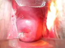 Esame obiettivo ginecologicoEsame obiettivo ginecologicoEsame interno con speculum di plastica: è ben visibile la cervice uterina. Non sono presenti processi patologici in atto. Modesta secrezione cervicale trasparente.