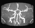 Poligono di Willis, immagine di risonanza magnetica, sequenze angiografiche, proiezione anteriore.