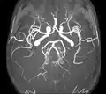 Poligono di Willis, immagine di risonanza magnetica, sequenze angiografiche, veduta dall'alto
