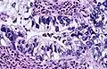 Immagine istologica BAdenocarcinoma a cellule chiare: le strutture cellulari si organizzano formando aggregati pseudo-ghiandolari. Le cellule appaiono chiare per la notevole presenza di muco.