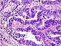 Adenocarcinoma del colon, colorazione con ematossilina-eosina