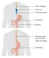 Illustrazione prima e dopo una parziale esofagectomia