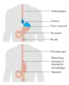 Illustrazione che mostra il prima e dopo di un intervento di esofagectomia