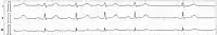 Aritmia sinusale: aumento fasico della frequenza cardiaca in ispirazione (per aumentato ritorno venoso) e rallentamento in espirazione (effetto vagale)