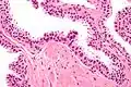 Neoplasia intraepiteliale prostatica di alto grado (PIN), colorazione con ematossilina-eosina, alto ingrandimento.