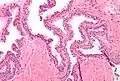 Neoplasia intraepiteliale prostatica di alto grado (PIN), colorazione con ematossilina-eosina, ingrandimento intermedio.