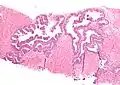 Neoplasia intraepiteliale prostatica di alto grado (PIN), colorazione con ematossilina-eosina, basso ingrandimento.