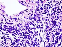 Immagine istologica E2Carcinoma polmonare a piccole cellule: ulteriore immagine istologica.