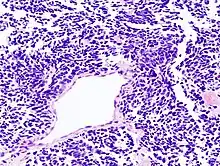 Immagine istologica E1Carcinoma polmonare a piccole cellule: le cellule con nucleo intensamente cromofilo e scarso citoplasma si accrescono assumendo una struttura compatta e dall'aspetto organoide.