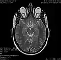 Un fotogramma di una risonanza magnetica della testa che mostra gli occhi e il cervello.