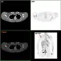 F-18 FDG PET/TC: un tumore mammario con metastasi sulla scapola destra.