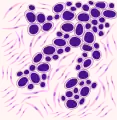 Rappresentazione ECarcinoma polmonare a piccole cellule: si può notare la scarsità del citoplasma e la presenza di nucleo intensamente cromofili. Le cellule si organizzano formando strutture compatte, dall'aspetto a palizzata.