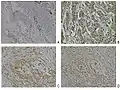 Espressione della neuropilina-2 nel tessuto normale e nel tessuto con carcinoma