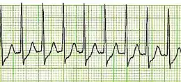 Tachicardia parossistica sopraventricolare: è un ritmo cardiaco ad alta frequenza, che origina al di sopra del ventricoli. Non sono visibili le onde P e la frequenza è in genere superiore ai 150 batt/min.