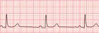 Bradicardia sinusale: si ha con l'abbassamento della frequenza cardiaca al di sotto di 60 battiti al minuto