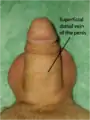 La vena dorsale superficiale visibile in un pene flaccido.