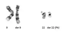 Philadelphias Translution T (9; 22) (Q34; Q11.2) visto in leucemia mielogena cronica.