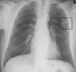 Radiografia del torace che mostra una neoformazione di forma ovalare nella parte periferica del lobo superiore sinistro