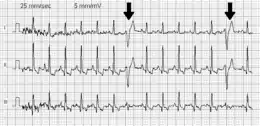 Extrasistole ventricolare: è un battito cardiaco prematuro, ossia un evento elettrico del muscolo cardiaco che avviene prima del previsto, alterando la successione regolare dei battiti nel ritmo sinusale.